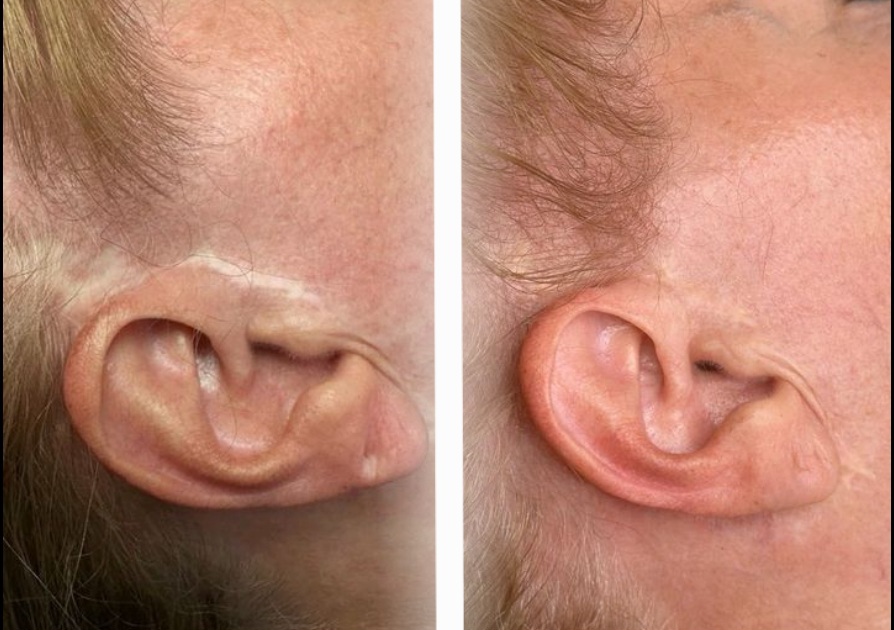 micropigmentacion cicatrices lifting marbella