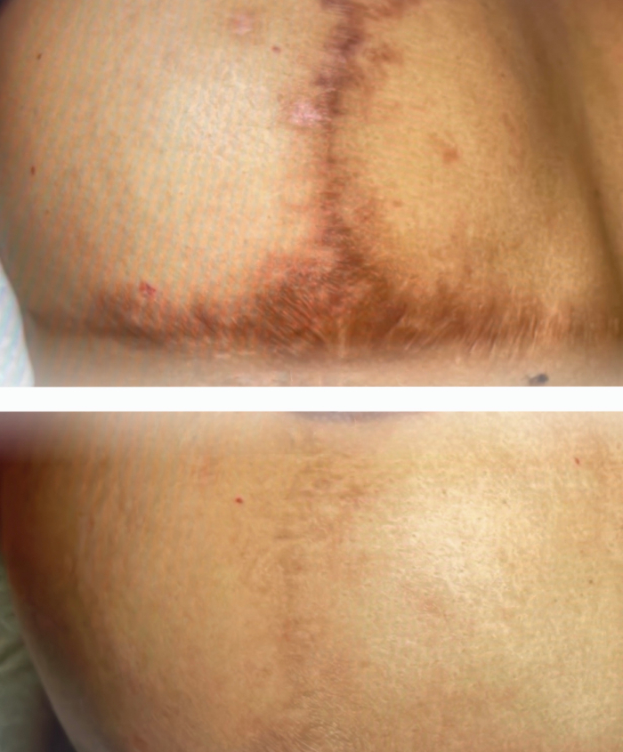 micropigmentacion cicatrices marbella