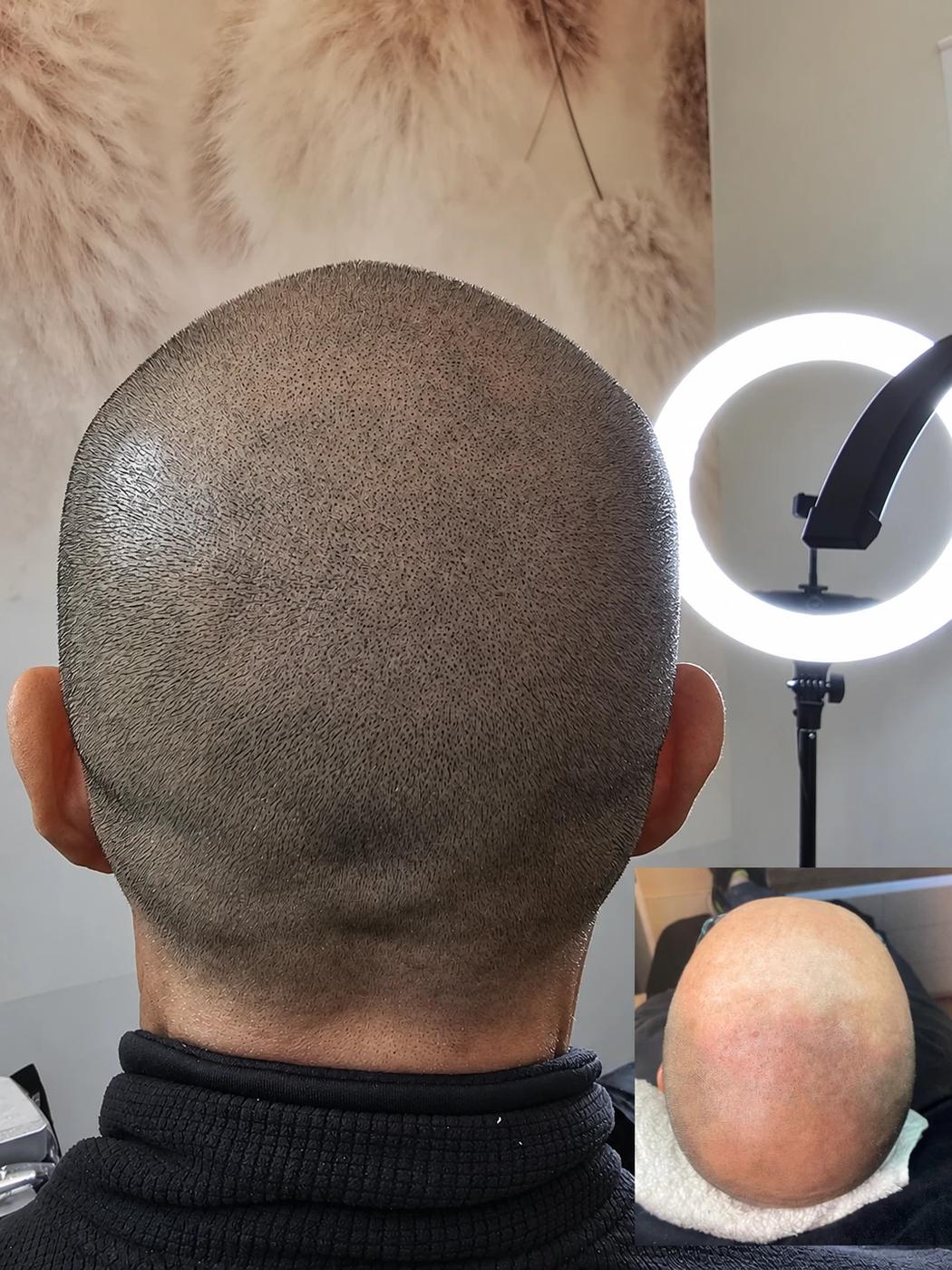 Resultado de micropigmentación capilar en la coronilla, Microscalp Lab Marbella
