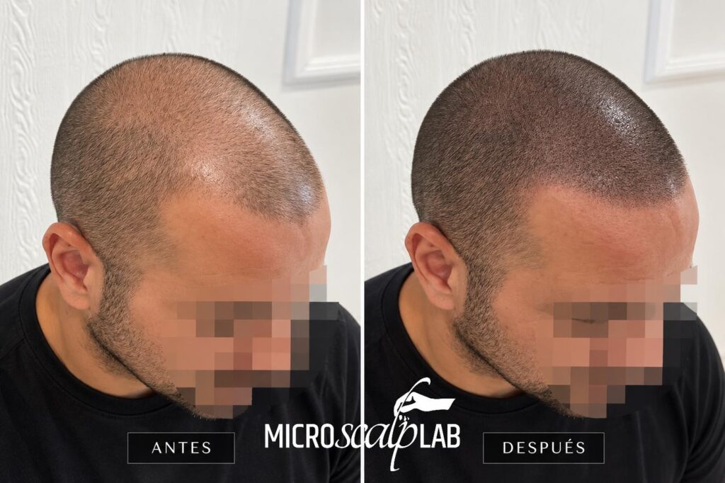 Trasplante capilar y micropigmentación antes y después